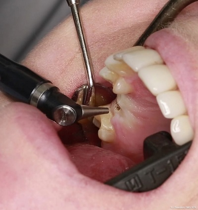 Dentist performing a procedure using laser on a patient. Mouth is open and the doctor is using laser on the upper set of teeth